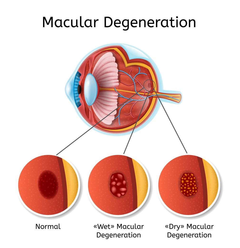 macular-degeneration-infographic