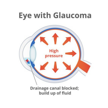 Eye with Glaucoma Infographic