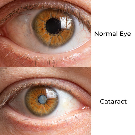 Comparison Of A Healthy Human Eye And An Eye With A Clouded Lens